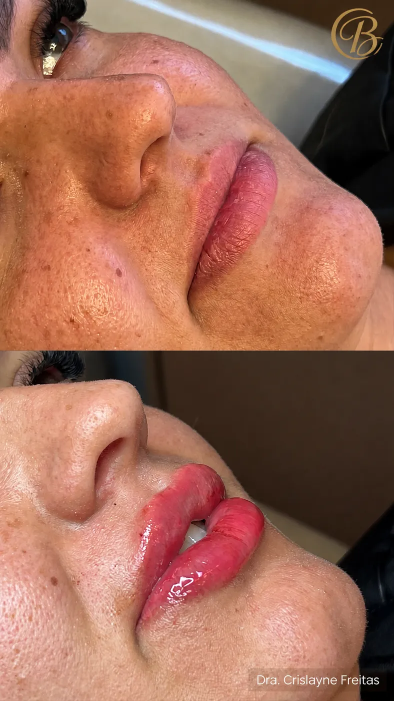 Antes e depois de preenchimento labial com contorno natural