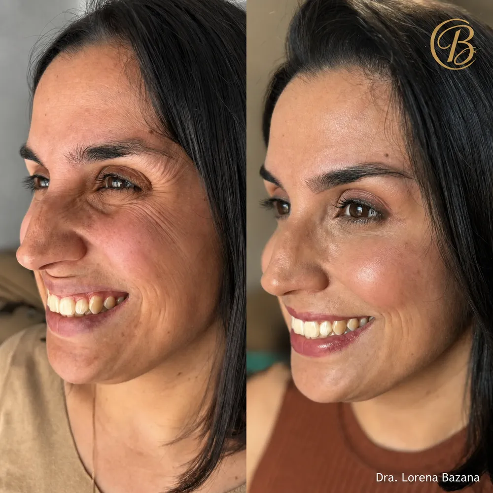 Antes e depois de rejuvenescimento facial: suavização de linhas ao redor dos olhos e do sorriso