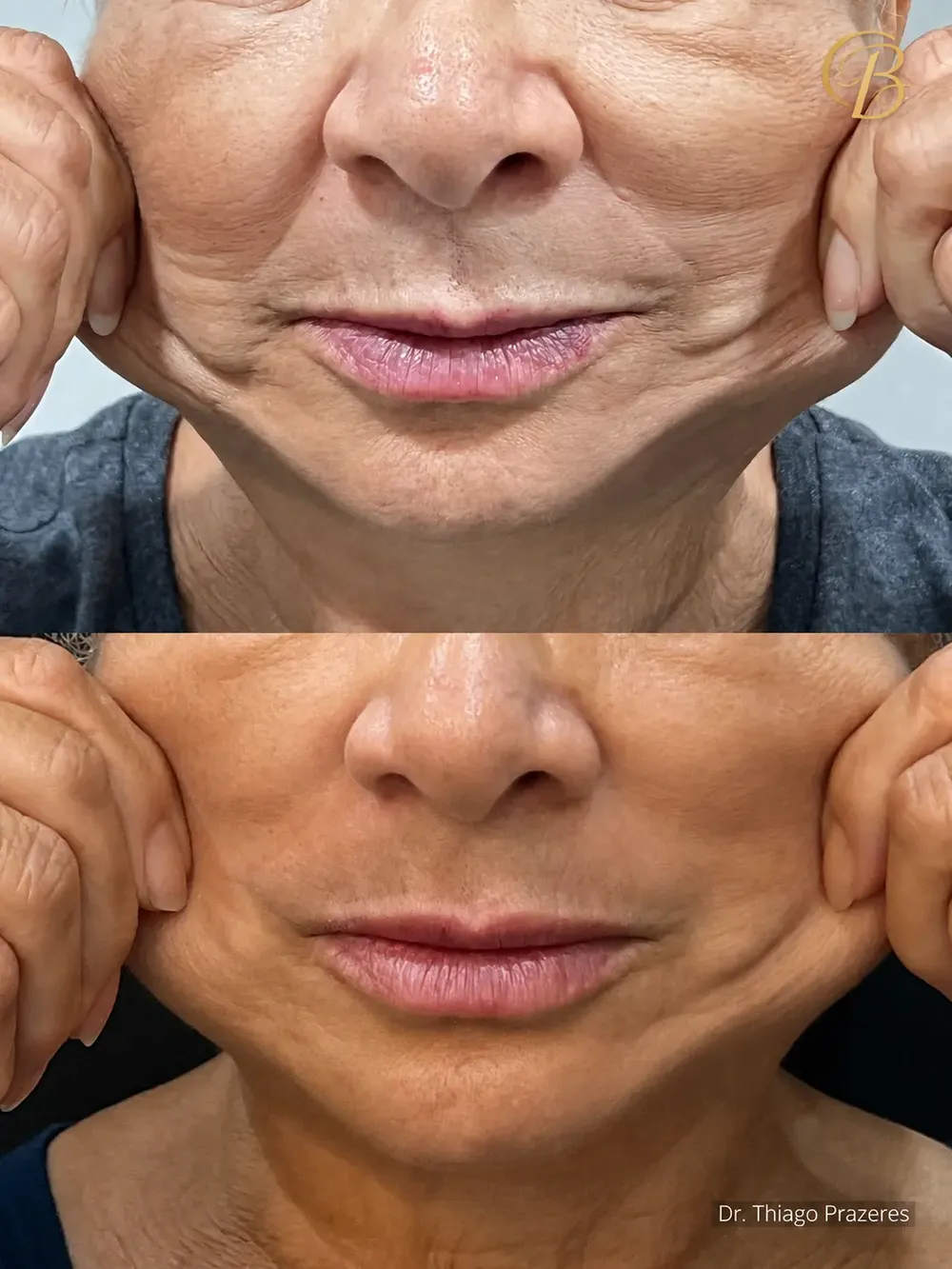 Antes e depois de tratamento facial: menos linhas ao redor da boca e do queixo