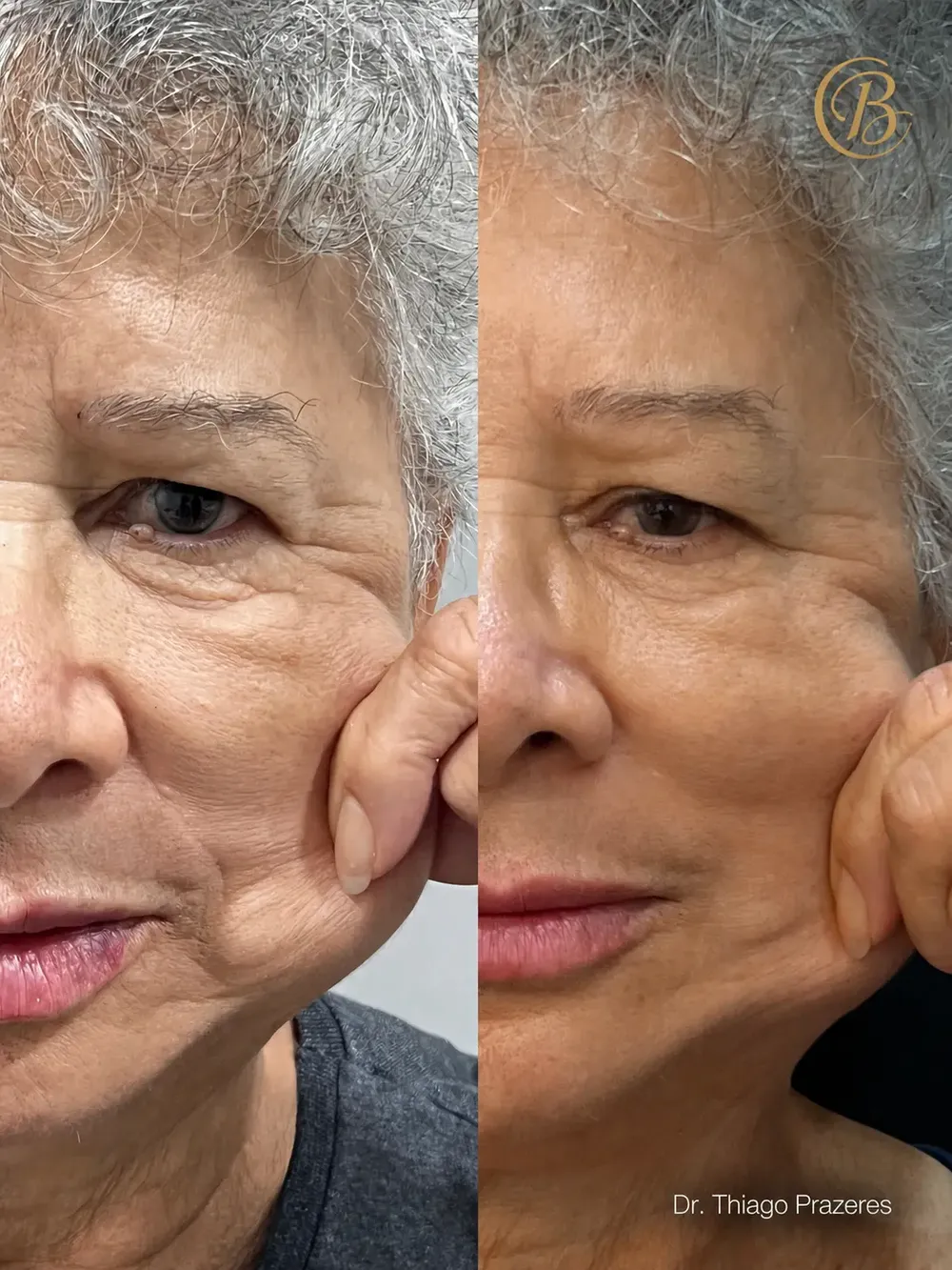 Antes e depois de bioestimulador: pele da bochecha mais firme e hidratada